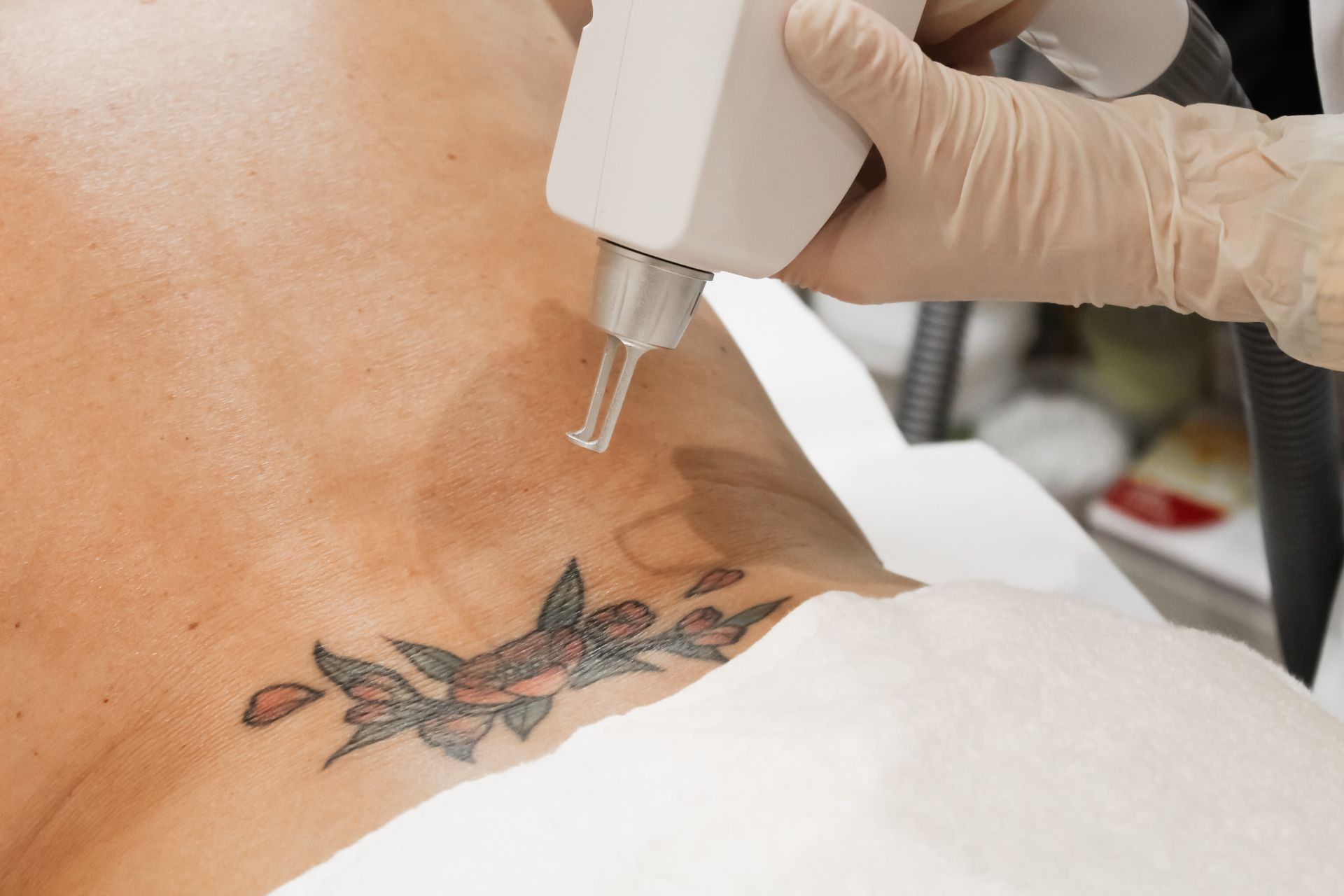 What is laser tattoo removal?