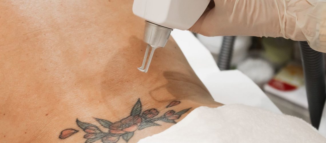 What is laser tattoo removal?